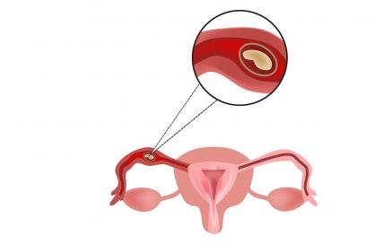 Внематочная беременность: симптомы, признаки разрыва трубы Алая кровь при внематочной беременности